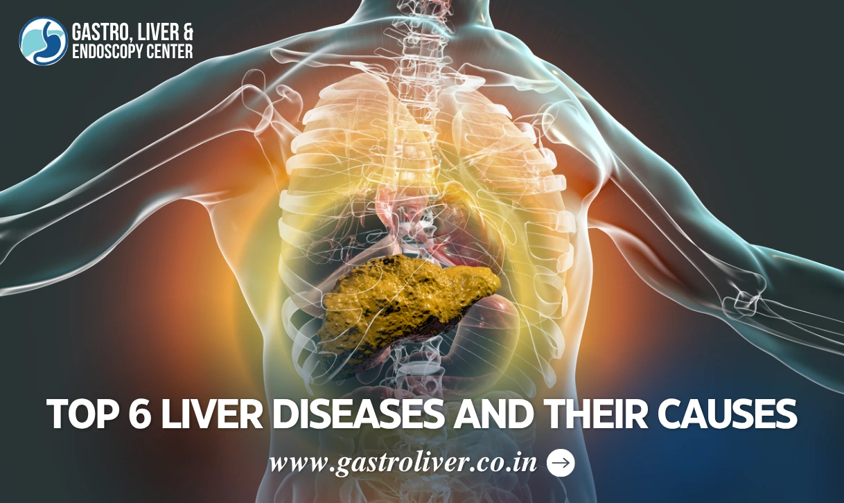 Top 6 Liver Diseases and Their Causes