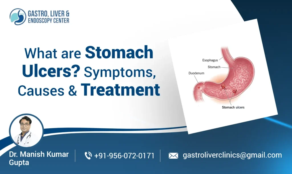 What Are Stomach Ulcers? Symptoms, Causes and Treatment