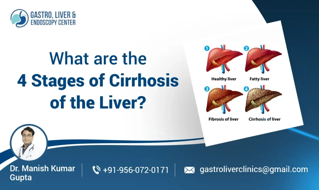 What are the 4 Stages of Cirrhosis of the Liver?