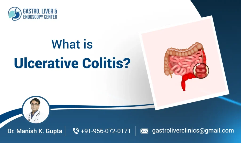 What is Ulcerative Colitis? Symptoms Causes and Treatments