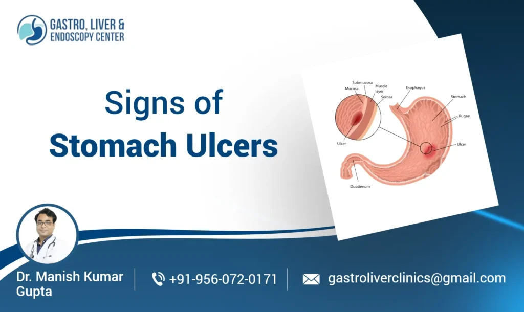 Signs and Symptoms of Stomach Ulcer