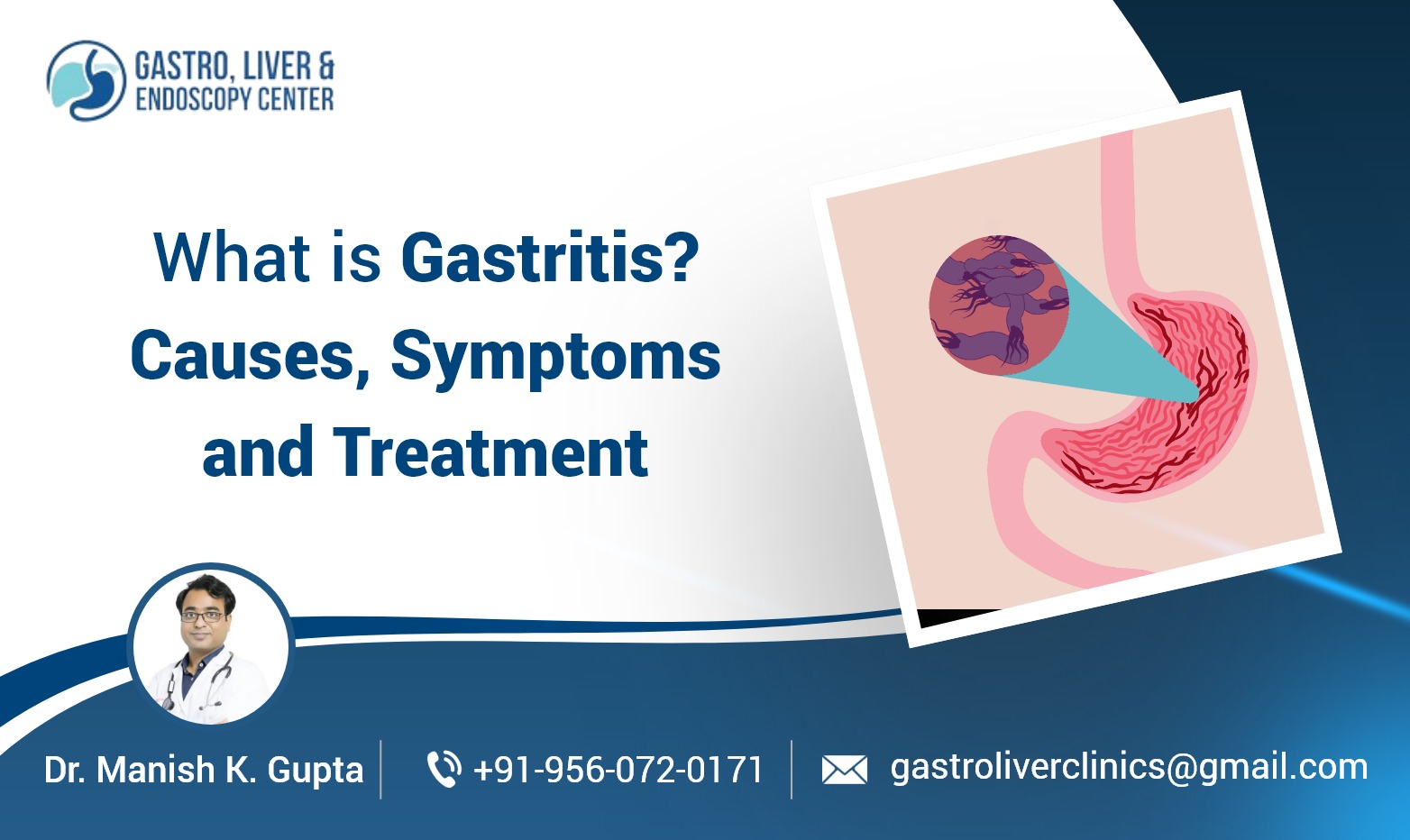 What is Gastritis​? Causes, Symptoms and Treatment