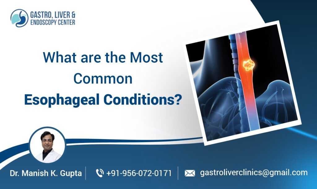 What are the Most Common Esophageal Conditions?
