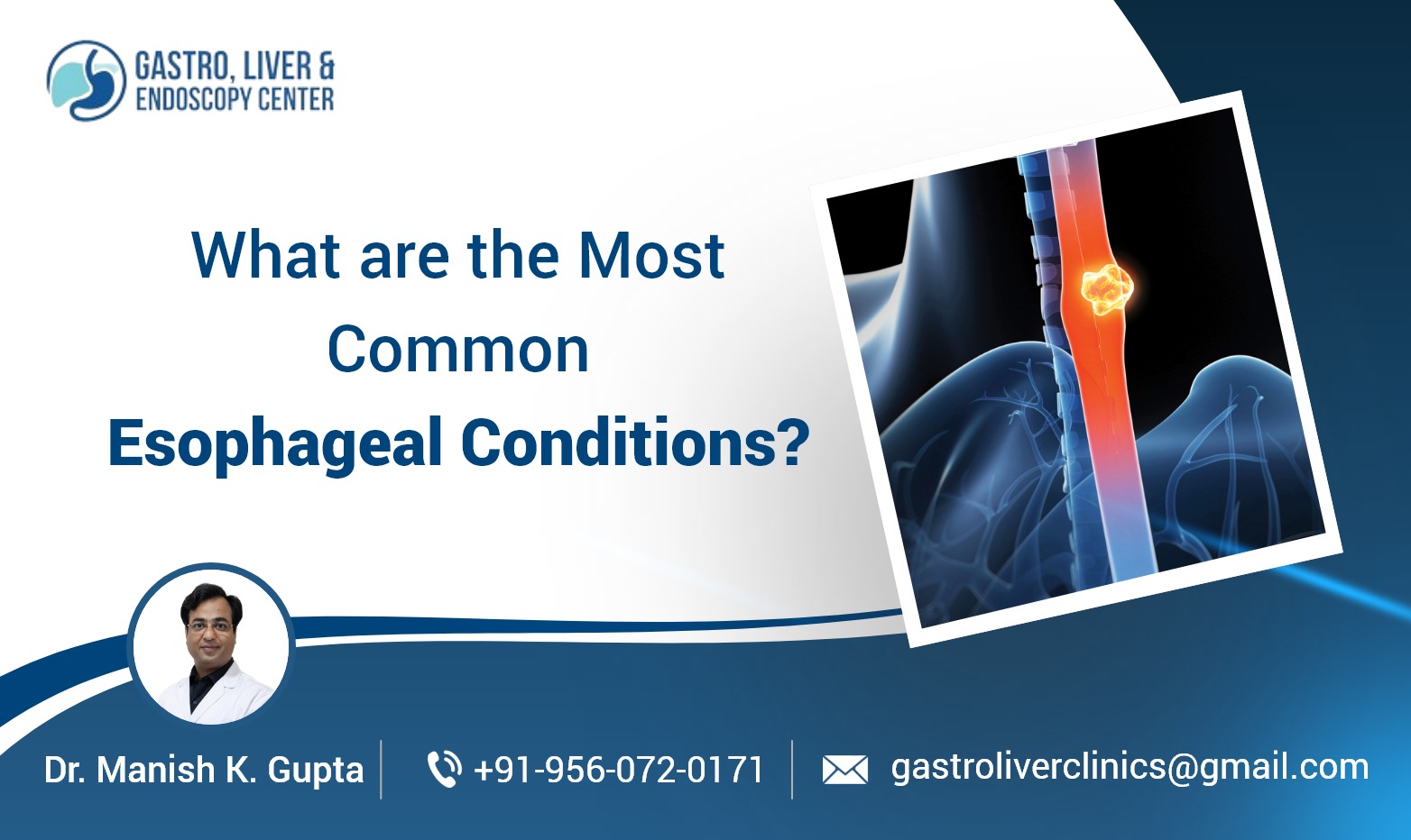 What are the Most Common Esophageal Conditions?