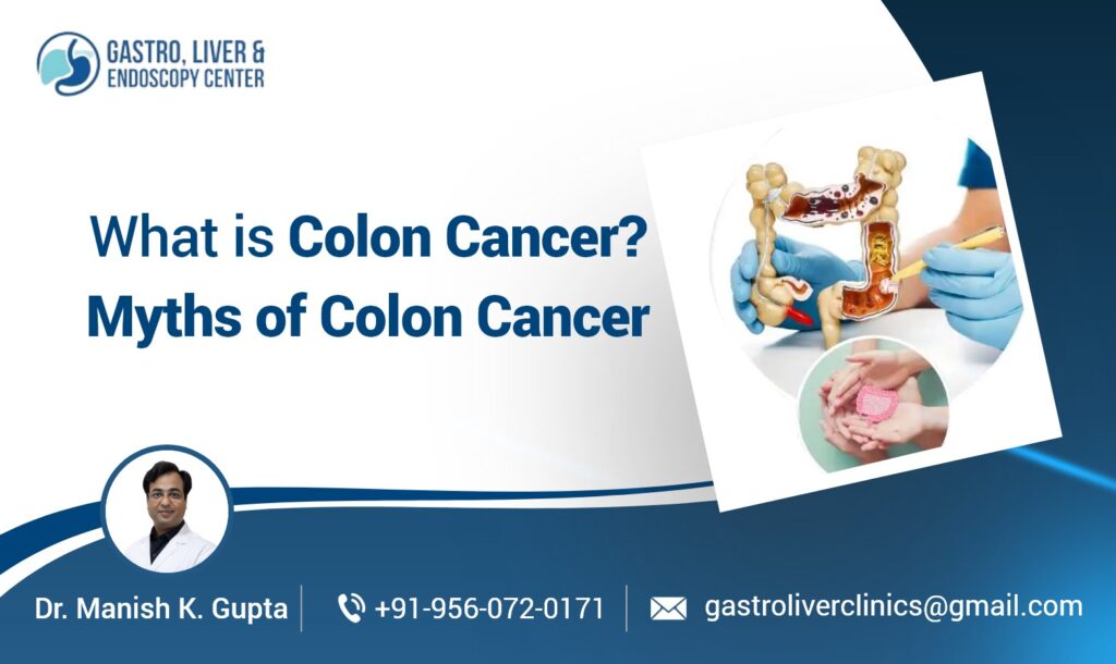 What is Colon Cancer​? Myths of Colon Cancer