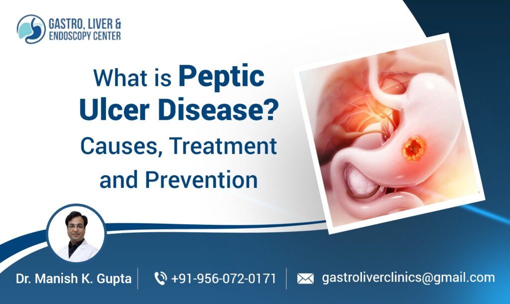 What is Peptic Ulcer Disease​? Causes, Treatment and Prevention
