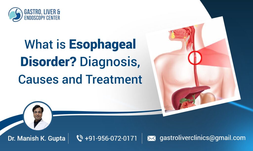 What is Esophageal Disorder? Diagnosis, Causes and Treatment